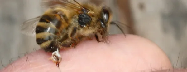 bee sting