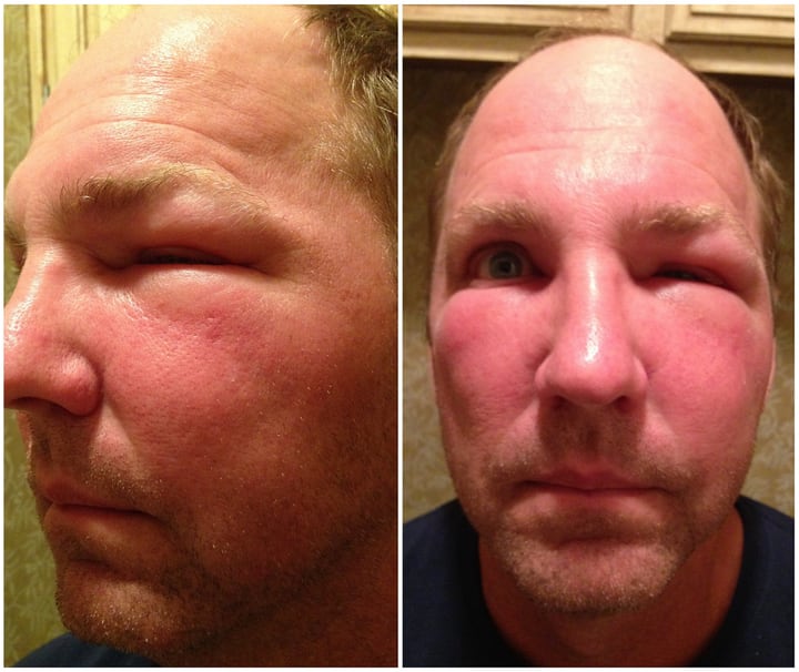 Bee Sting 101 Easy Guide On How To Deal With Bee Stings