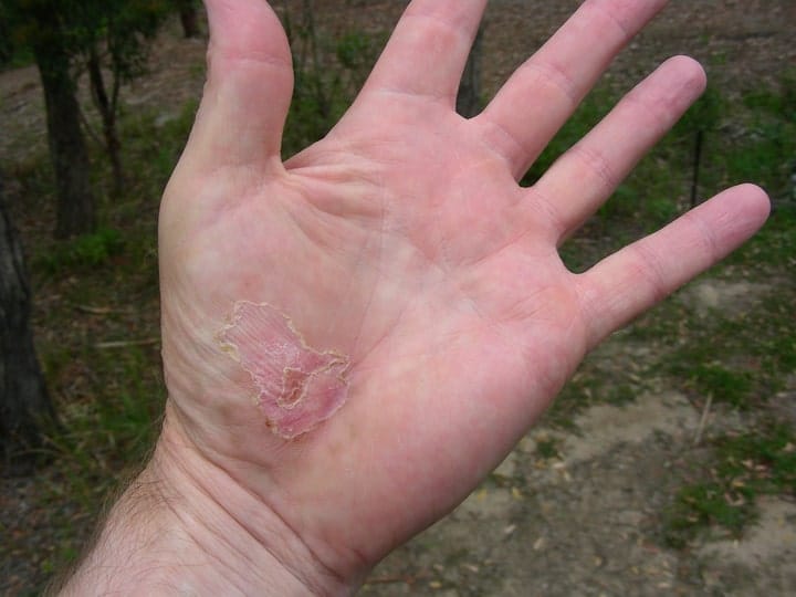 healed bicycle wound on the palm