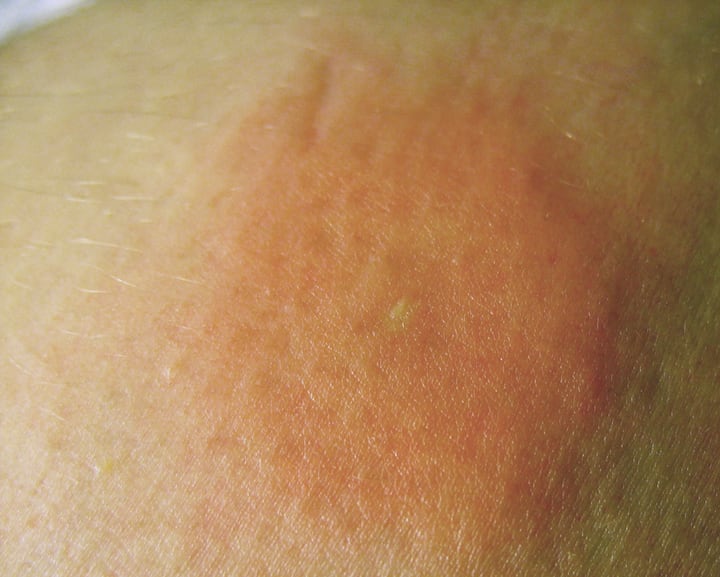 moderate bee sting